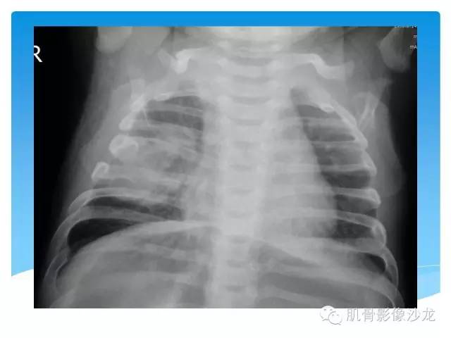 【病例】婴幼儿胸壁错构瘤1例CT影像表现 【病例】婴幼儿胸壁错构瘤1例CT影像表现