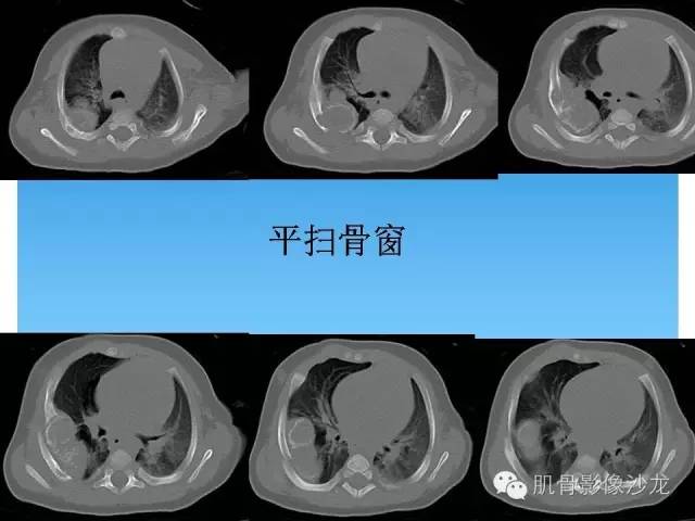 【病例】婴幼儿胸壁错构瘤1例CT影像表现 【病例】婴幼儿胸壁错构瘤1例CT影像表现