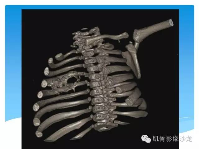 【病例】婴幼儿胸壁错构瘤1例CT影像表现 【病例】婴幼儿胸壁错构瘤1例CT影像表现