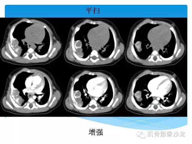 【病例】婴幼儿胸壁错构瘤1例CT影像表现 【病例】婴幼儿胸壁错构瘤1例CT影像表现