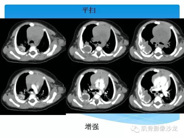 【病例】婴幼儿胸壁错构瘤1例CT影像表现 【病例】婴幼儿胸壁错构瘤1例CT影像表现