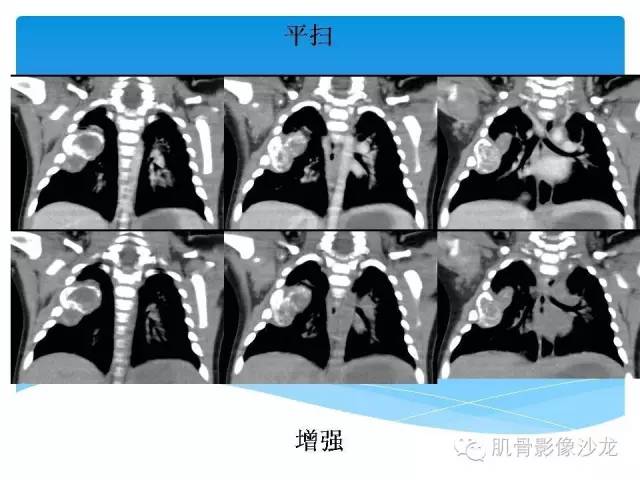 【病例】婴幼儿胸壁错构瘤1例CT影像表现 【病例】婴幼儿胸壁错构瘤1例CT影像表现