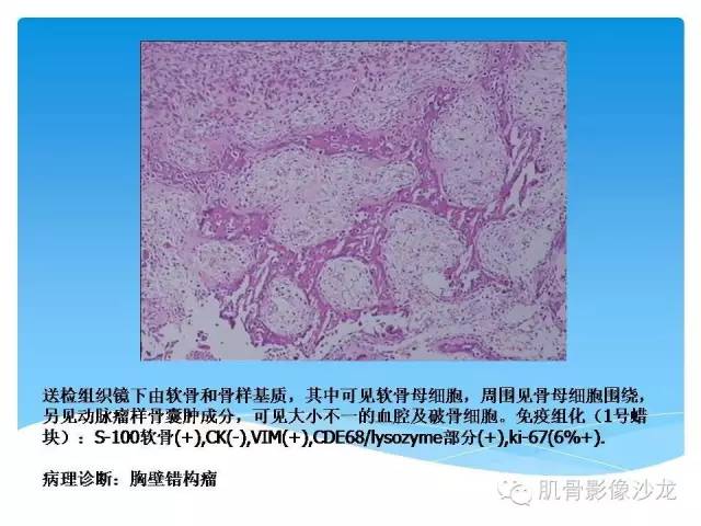 【病例】婴幼儿胸壁错构瘤1例CT影像表现 【病例】婴幼儿胸壁错构瘤1例CT影像表现