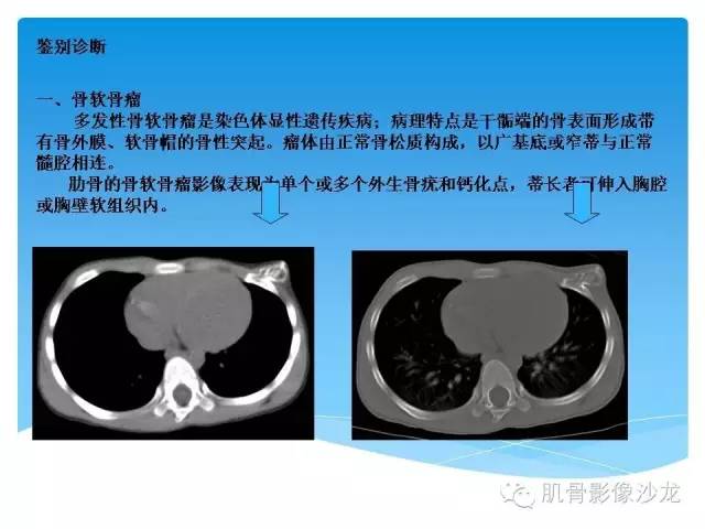 【病例】婴幼儿胸壁错构瘤1例CT影像表现 【病例】婴幼儿胸壁错构瘤1例CT影像表现