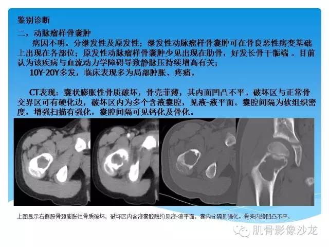 【病例】婴幼儿胸壁错构瘤1例CT影像表现 【病例】婴幼儿胸壁错构瘤1例CT影像表现