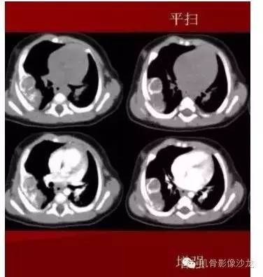 【病例】婴幼儿胸壁错构瘤1例CT影像表现 【病例】婴幼儿胸壁错构瘤1例CT影像表现