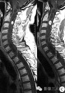 【病例】上颈段髓内血管畸形1例MR影像表现