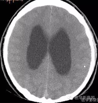 【病例】脑囊虫病1例CT及MR影像表现 【病例】脑囊虫病1例CT及MR影像表现
