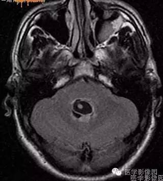【病例】脑囊虫病1例CT及MR影像表现