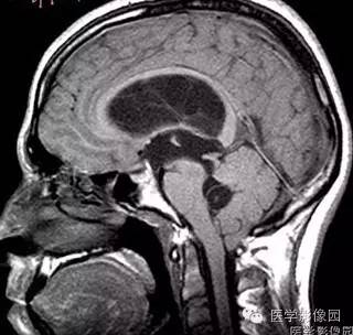 【病例】脑囊虫病1例CT及MR影像表现 【病例】脑囊虫病1例CT及MR影像表现