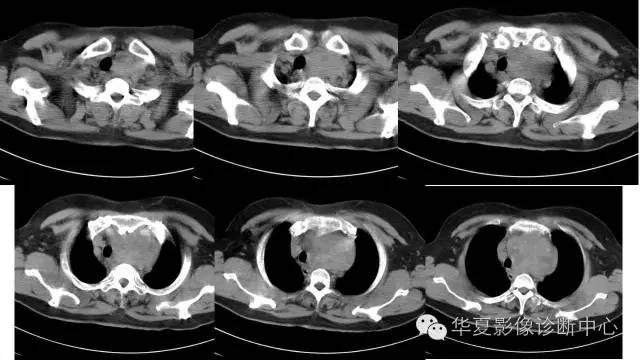 【病例】胸骨后甲状腺肿1例CT及MR影像表现