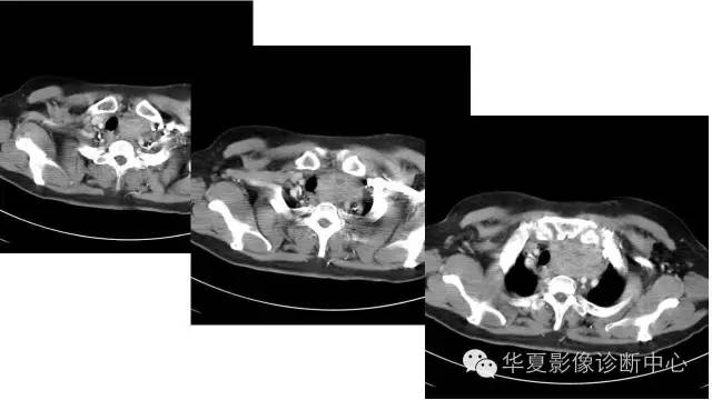 【病例】胸骨后甲状腺肿1例CT及MR影像表现