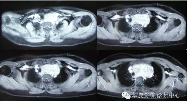 【病例】胸骨后甲状腺肿1例CT及MR影像表现