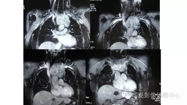 【病例】胸骨后甲状腺肿1例CT及MR影像表现