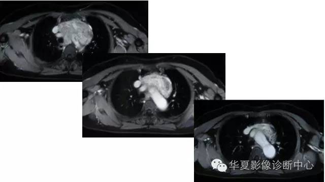 【病例】胸骨后甲状腺肿1例CT及MR影像表现