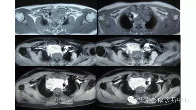 【病例】胸骨后甲状腺肿1例CT及MR影像表现