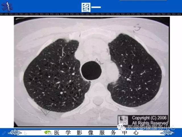 【PPT】少见症之Mounier-Kuhn综合症