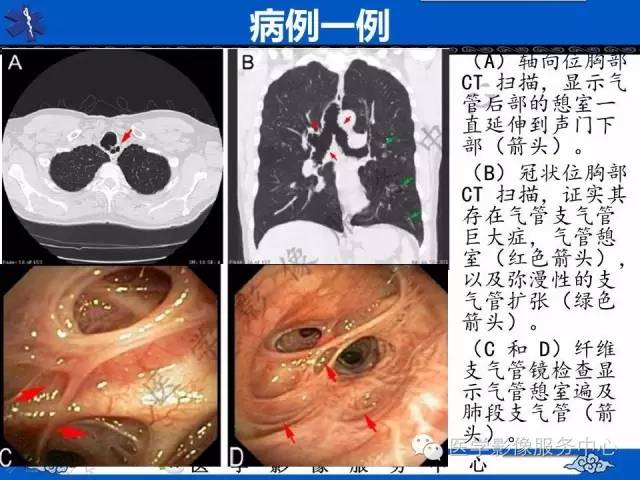 【PPT】少见症之Mounier-Kuhn综合症