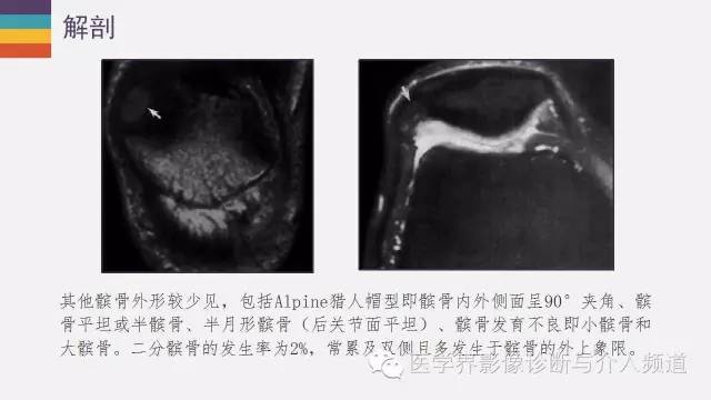 【PPT】髌股关节MR