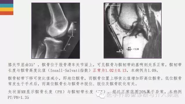 【PPT】髌股关节MR