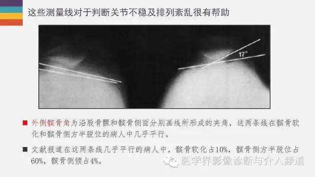 【PPT】髌股关节MR