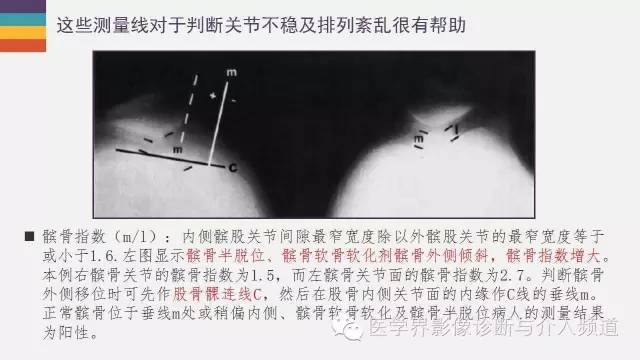 【PPT】髌股关节MR