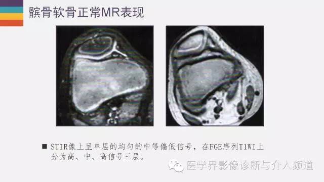 【PPT】髌股关节MR