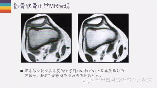 【PPT】髌股关节MR