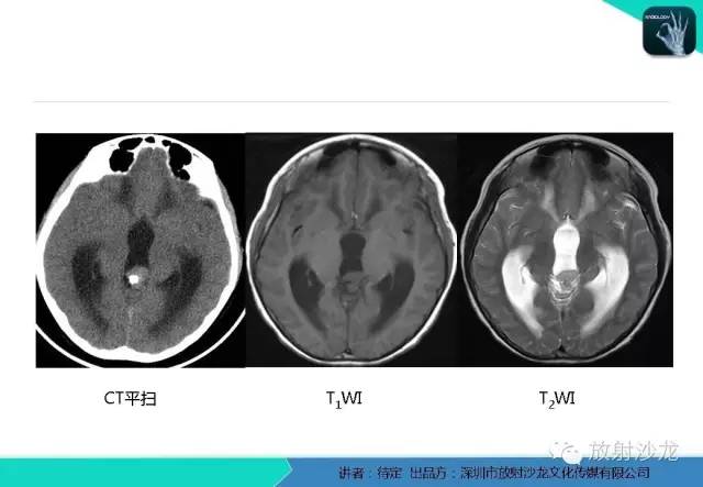 【病例】松果体区生殖细胞瘤1例CT及MR影像表现
