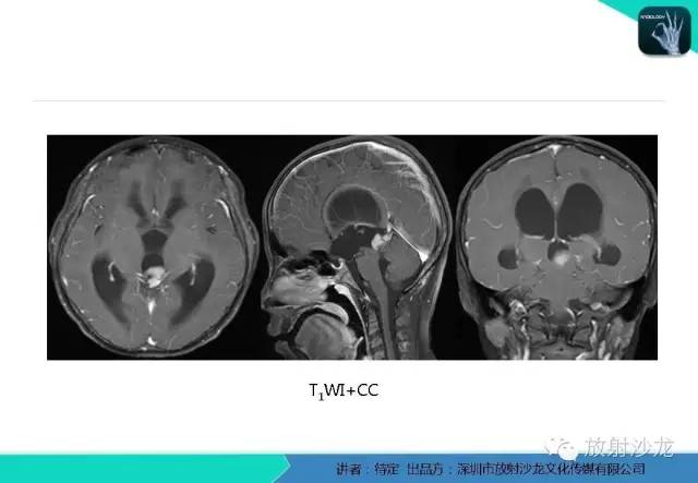 【病例】松果体区生殖细胞瘤1例CT及MR影像表现