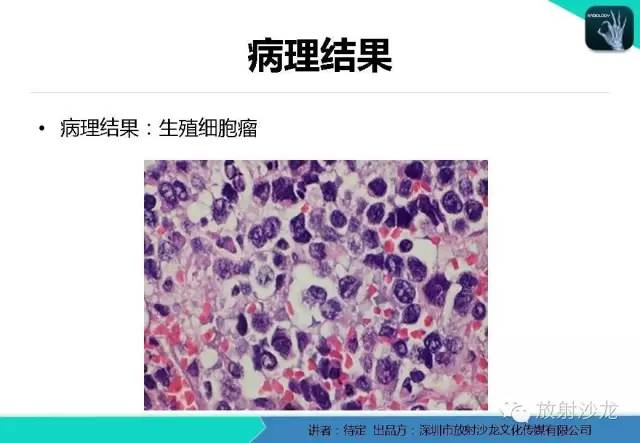 【病例】松果体区生殖细胞瘤1例CT及MR影像表现