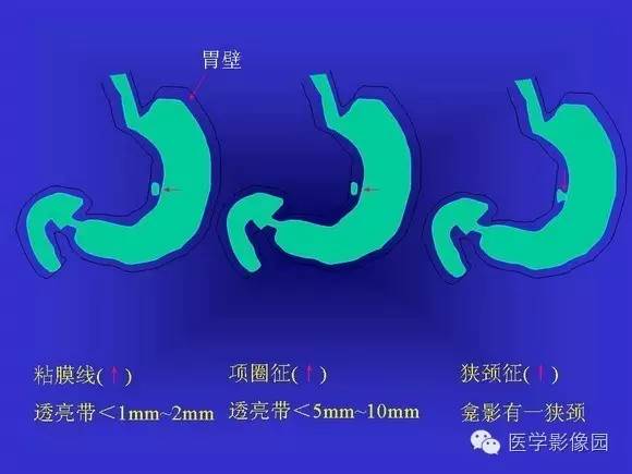【PPT】上消化道溃疡与胃癌的影像学表现