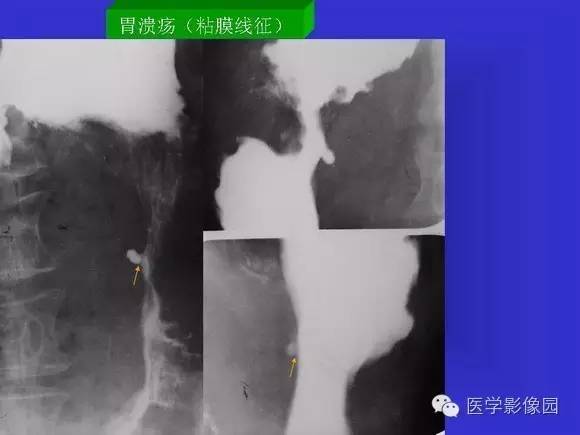 【PPT】上消化道溃疡与胃癌的影像学表现