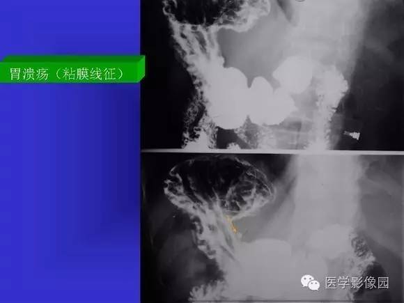 【PPT】上消化道溃疡与胃癌的影像学表现