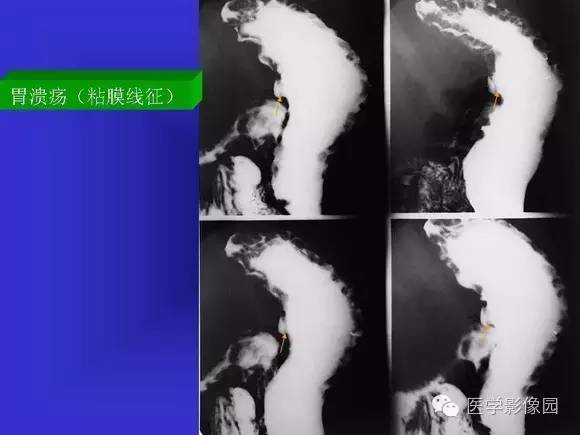 【PPT】上消化道溃疡与胃癌的影像学表现
