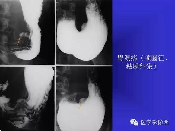 【PPT】上消化道溃疡与胃癌的影像学表现