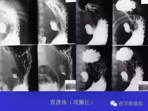 【PPT】上消化道溃疡与胃癌的影像学表现