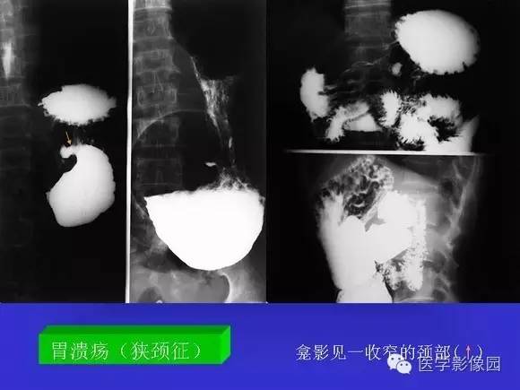 【PPT】上消化道溃疡与胃癌的影像学表现