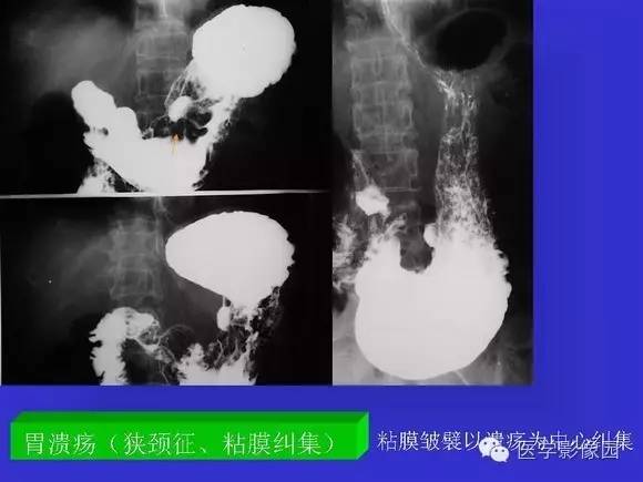 【PPT】上消化道溃疡与胃癌的影像学表现