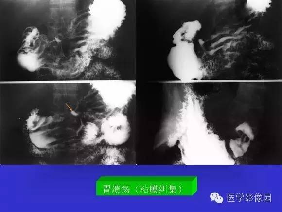 【PPT】上消化道溃疡与胃癌的影像学表现