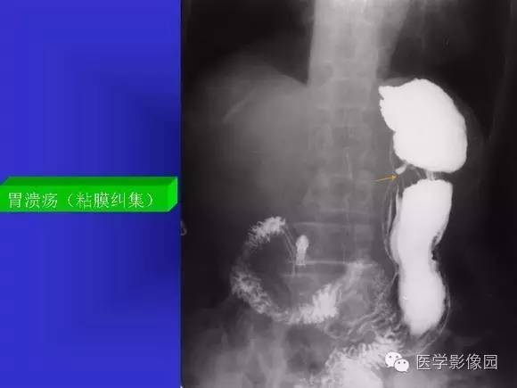 【PPT】上消化道溃疡与胃癌的影像学表现