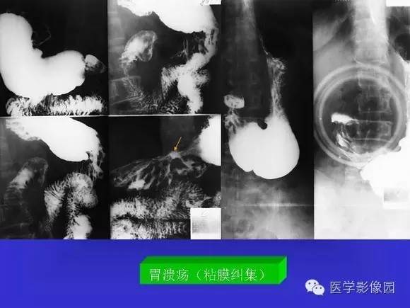 【PPT】上消化道溃疡与胃癌的影像学表现
