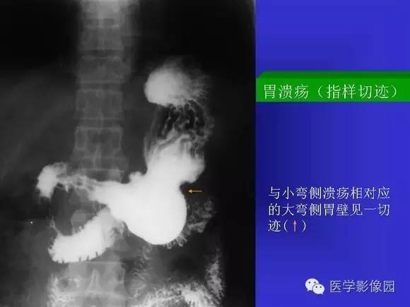 【PPT】上消化道溃疡与胃癌的影像学表现