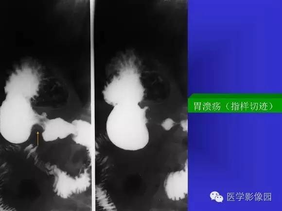 【PPT】上消化道溃疡与胃癌的影像学表现