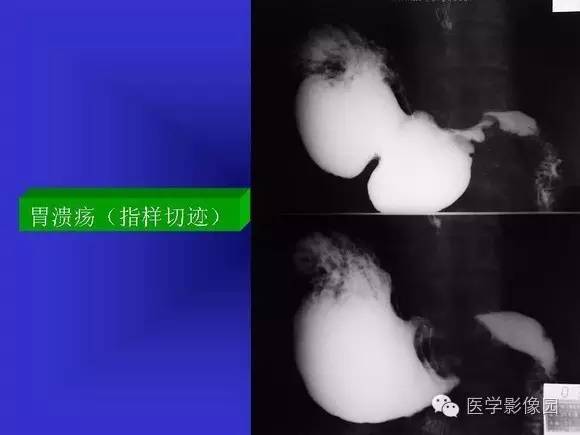 【PPT】上消化道溃疡与胃癌的影像学表现