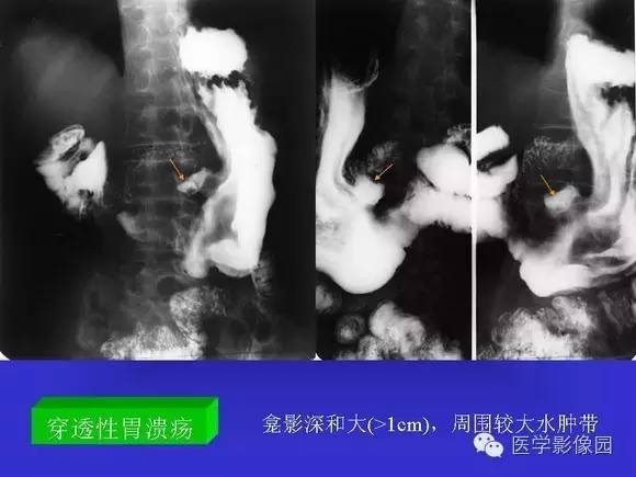 【PPT】上消化道溃疡与胃癌的影像学表现