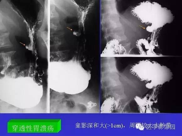 【PPT】上消化道溃疡与胃癌的影像学表现