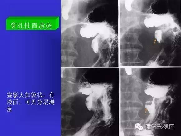 【PPT】上消化道溃疡与胃癌的影像学表现