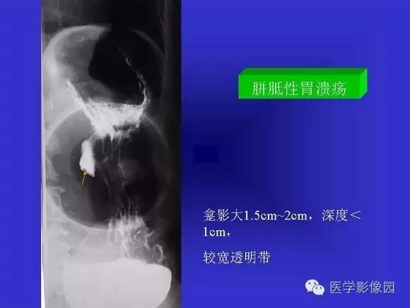 【PPT】上消化道溃疡与胃癌的影像学表现
