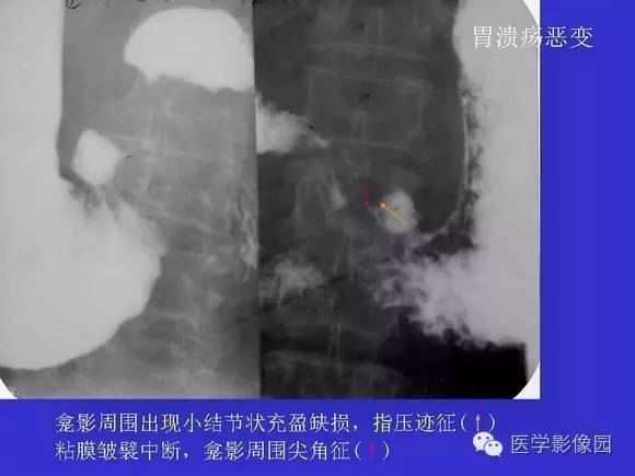 【PPT】上消化道溃疡与胃癌的影像学表现